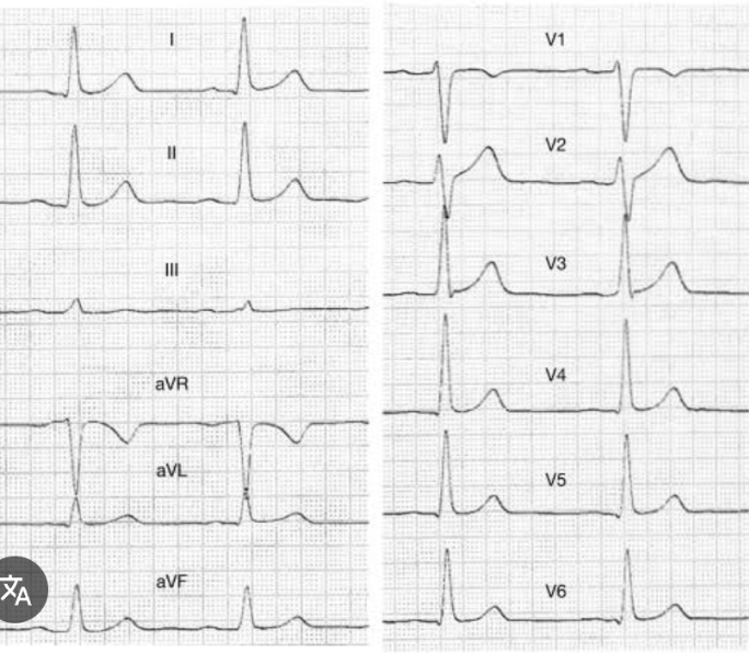 <p>records the electrical activity of the heart. The ECG is used to diagnose cardiac disease, monitor patient response to drug therapy, and monitor for adverse drug effects.</p>