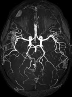 <p>What imaging is seen here of the cranial vessels?</p>