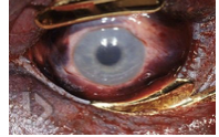 <ul><li><p><span>pressure on chest and abdomen making it impossible to breath; most accidents</span></p></li><li><p><span>face and neck are deep purple from congestion; petechiae of conjunctiva and sclera, confluent scleral hemorrhage</span></p></li></ul><p></p>