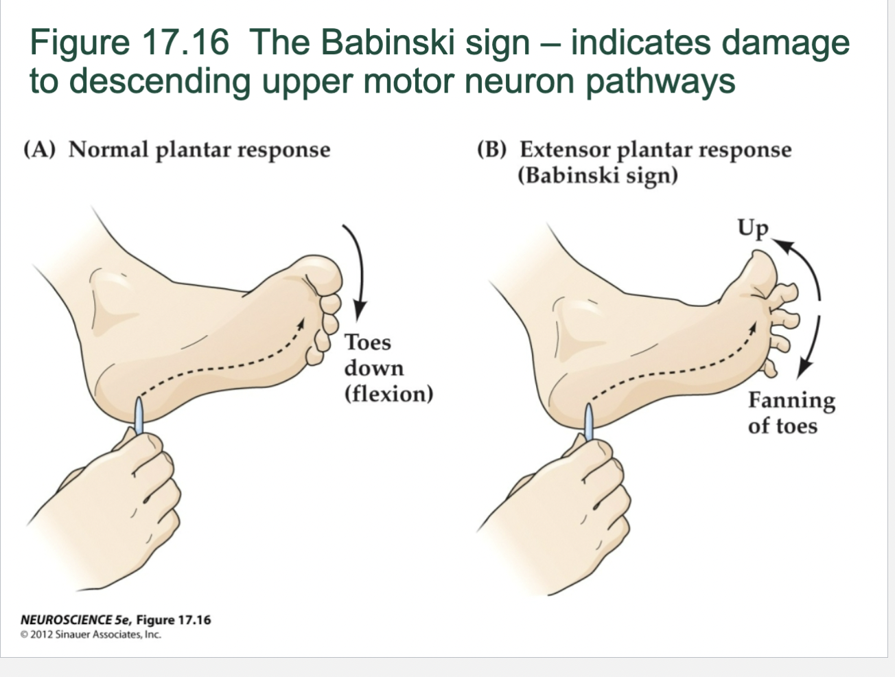 <p>Babinski Sign</p>
