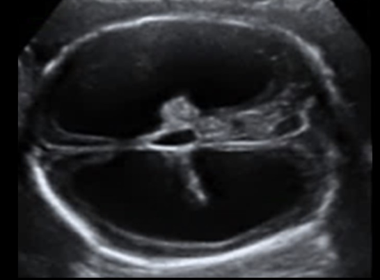 <p>which is <strong>not a cause</strong> for this abn</p><p>a) anencephaly</p><p>b) aqueductal stenosis</p><p>c) chiari malformation</p><p>d) teratoma </p>