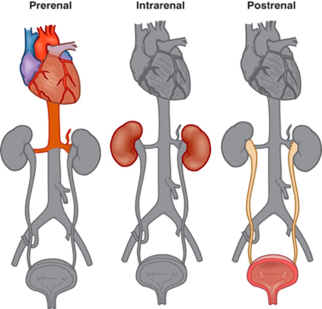 <p><span class="bgB">Sepsis</span></p><p><span class="bgY">Cardiac surgery</span></p><p><span class="bgP">Cardiac failure</span></p><p><span class="bgB">Respiratory failure</span></p><p><span class="bgY">Mechanical ventilation or PEEP</span></p><p><span class="bgP">Trauma</span></p><p><span class="bgB">Rhabdomyolysis</span></p><p><span class="bgP">Chronic Kidney Disease</span></p><p><span class="bgY">Contrast Dye</span></p>