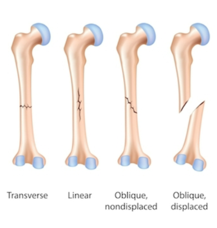 Position of bone ends after fracture: displaced (not lined up) or non-displaced (lined up)

Completeness: complete or incomplete

Orientation relative to long axis: linear, transverse, or oblique Skin penetration: open or closed