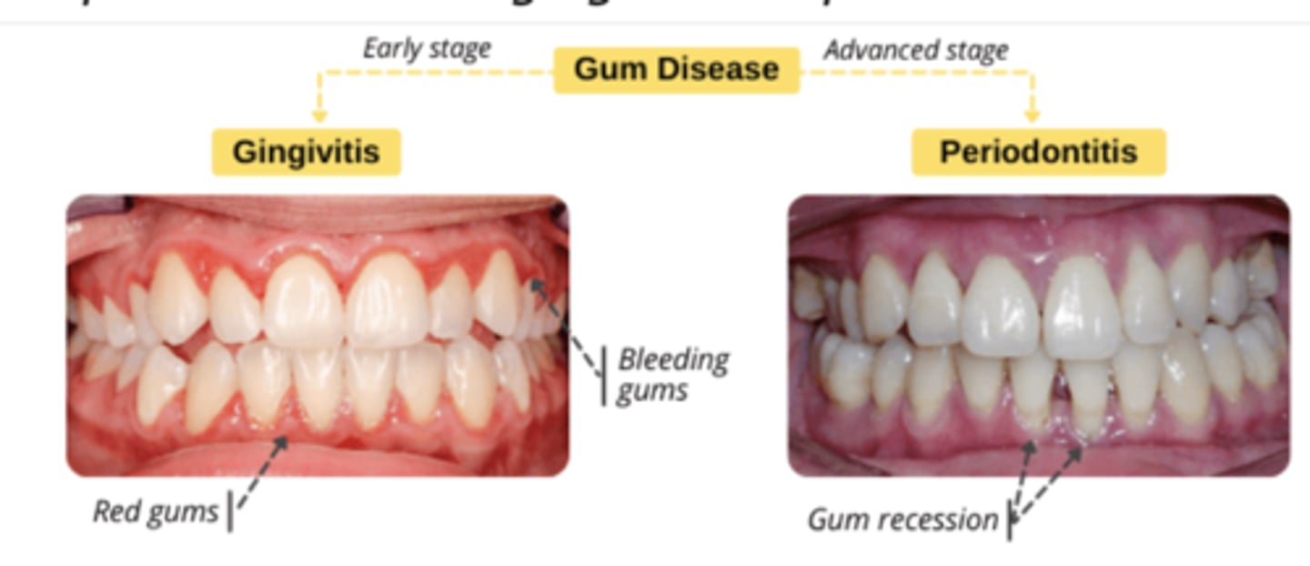 <p>-progression from untreated gingivitis </p><p>-non-reversible </p><p>- caused by <strong>anaerobic bacteria</strong> </p><p>-more severe and chronic condition that involves infection of the <strong>deeper tissues, including bone</strong>, and can lead to permanent damage and tooth loss if untreated </p><p></p><p>-SX: <strong>receding gums</strong>, formation of <strong>deep pockets</strong>, <strong>tooth mobility</strong>, and eventually <strong>tooth loss</strong>.</p>