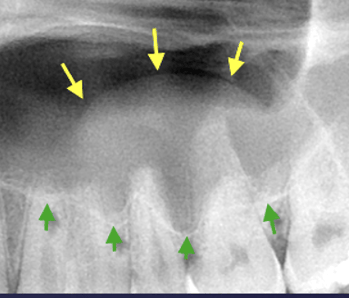 <p>What is the differential diagnosis?</p><p>A) Rarefying osteitis</p><p>B) Maxillary sinus pneumatization</p><p>C) Mucus retention pseudocyst</p><p>D) Sclerosing osteitis</p>