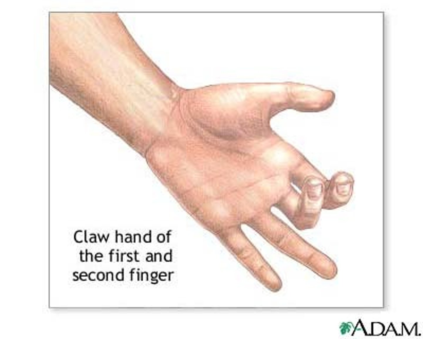 <p>Claw hand deformity </p><p>Small muscles of hand wasted (except thenar eminance and lateral lumbricals which are innervated by the median nerve).</p>