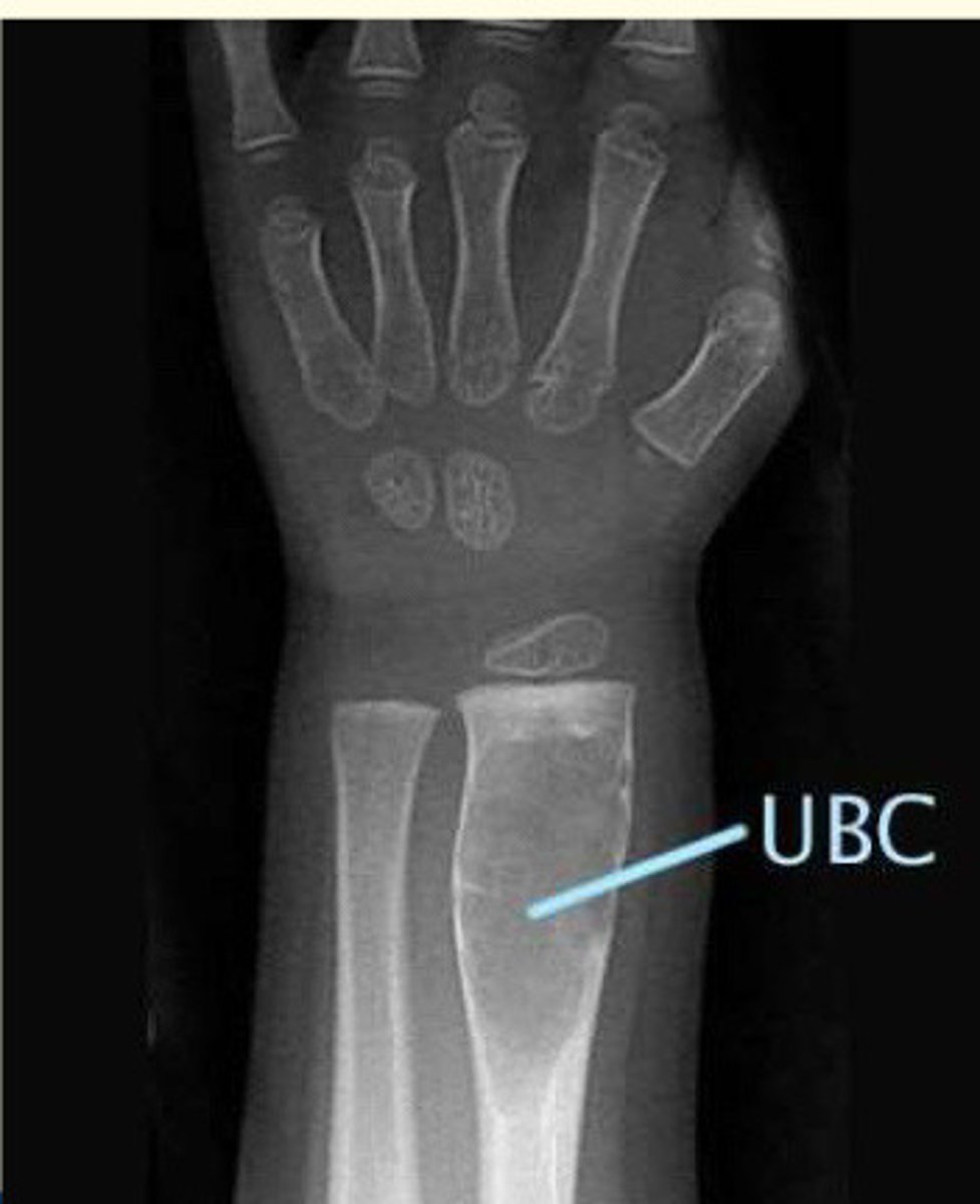 <p>Fluid filled spots inside bones which develop during growth of bones</p><p>These usually do not cause issues but can occasionally weaken bones enough to break</p>