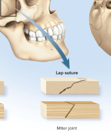 <p>Lap sutures (squamous sutures)</p>