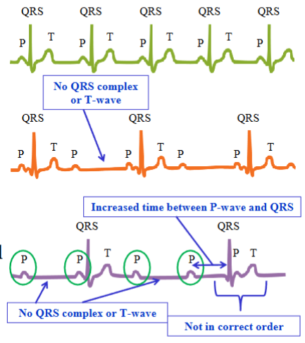 <ul><li><p><span style="color: rgb(0, 0, 0);"><span>Many myocardial defects alter normal action potential propagation, and as a result the shapes and timing of the waves on the ECG vary</span></span></p></li><li><p><span style="color: rgb(0, 0, 0);"><span>AV node block: a type of heart block in which conduction between the atria and ventricles is impaired; partial or complete interruption of the impulse from the atria to the ventricles</span></span><span style="color: transparent;"><span>Partial AV node block: the damaged AV node permits only </span></span></p></li><li><p><span style="color: rgb(0, 0, 0);"><span>Partial AV node block: the damaged AV node permits only every other atrial impulse to be transmitted to the ventricles; every second P-wave is not followed by a QRS complex or a T-wave</span></span></p></li><li><p><span style="color: rgb(0, 0, 0);"><span>Complete AV node block: electrical depolarizations of the atria are not transmitted to the ventricles; no synchrony between atrial and ventricular electrical activities</span></span></p></li><li><p><span style="color: rgb(0, 0, 0);"><span>Any component of the heart’s conduction system is capable of initiating action</span></span><span style="color: rgb(0, 0, 0);"><br></span><span style="color: rgb(0, 0, 0);"><span>potentials to drive the heart</span></span></p></li><li><p><span style="color: rgb(0, 0, 0);"><span>Different regions generate action potentials at different rates</span></span><span style="color: rgb(0, 0, 0);"><br></span><span style="color: rgb(0, 0, 0);"><span>- SAN generates action potentials at fastest rate; in a normal healthy heart, the SAN generates APs which drive the rest of the hearts conducting system; heart’s pacemaker</span></span></p><p><span style="color: rgb(0, 0, 0);"><br></span></p></li></ul><p></p>