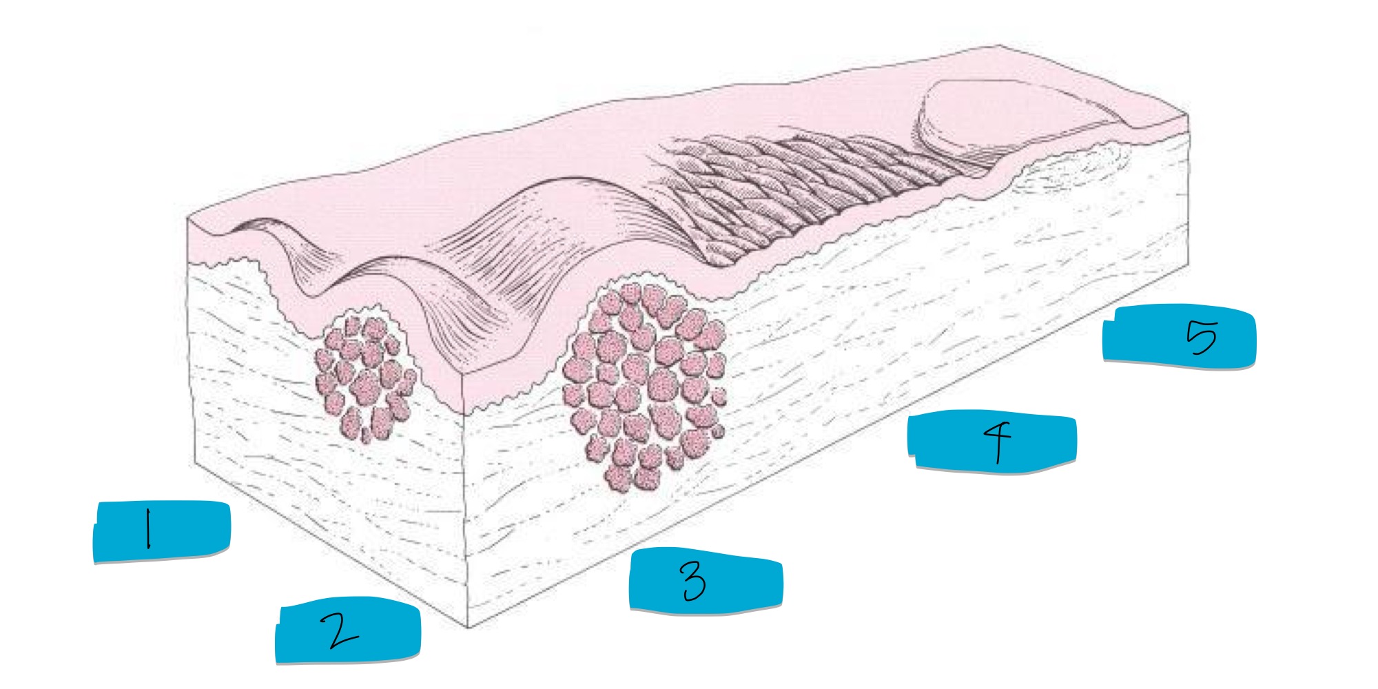 <p>name these skin lesions </p>