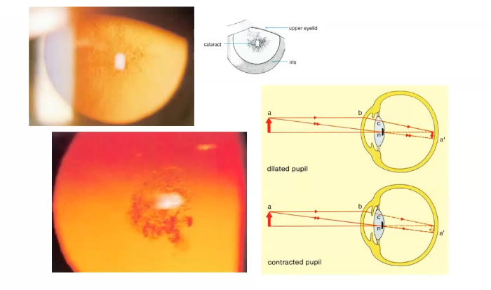 <p>sub- capsular cataract- shown on retro illumination of lens from retina</p>