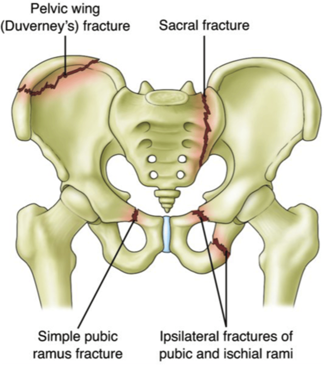 <p>generally result from a high force injury (ex. MVA) accompanies by multiple internal trauma</p><p>STRUCTURE--&gt; pelvic ring with generally more than one site</p><p>FUNCTIONAL DEFICITS--&gt; pain with ambulation or inability to ambulate</p><p>COMPENSATORY MOVEMENTS--&gt; slow antalgic, may need assistive device, may require fixation of the fracture sites</p>