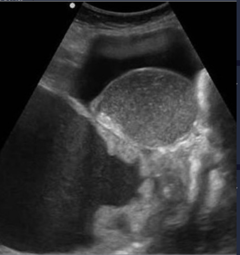 <p>All stages of ovarian cancer have ____</p>