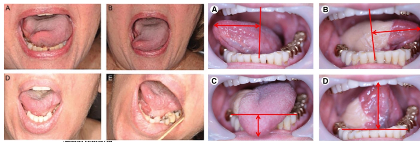 <p>Primair sluiten zorgt voor mobiliteitsbeperking <br>(oppervlakteverkleining)<br>Reconstructie van mucosaal oppervlak (niet spier) is nodig voor <br>herstel tongmobiliteit<br>Meestal vrije voorarmflap (radialisflap)</p><p>linker persoon is niet succesvolle reconstructie</p>