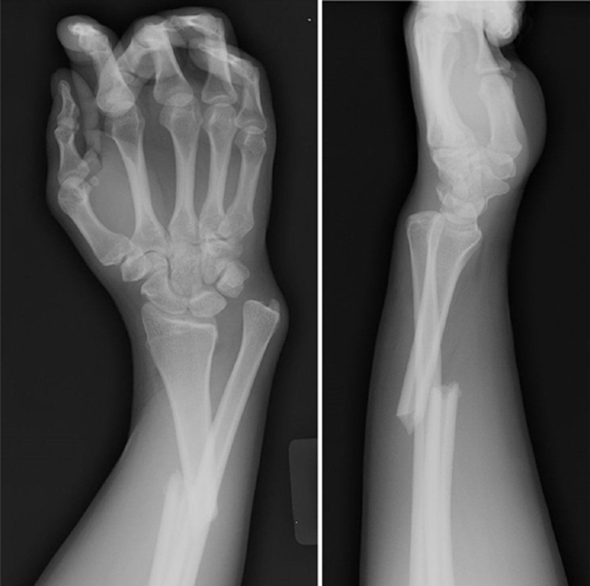 <p>Fracture of the radius and the dislocation or subluxation of the DRUJ</p>