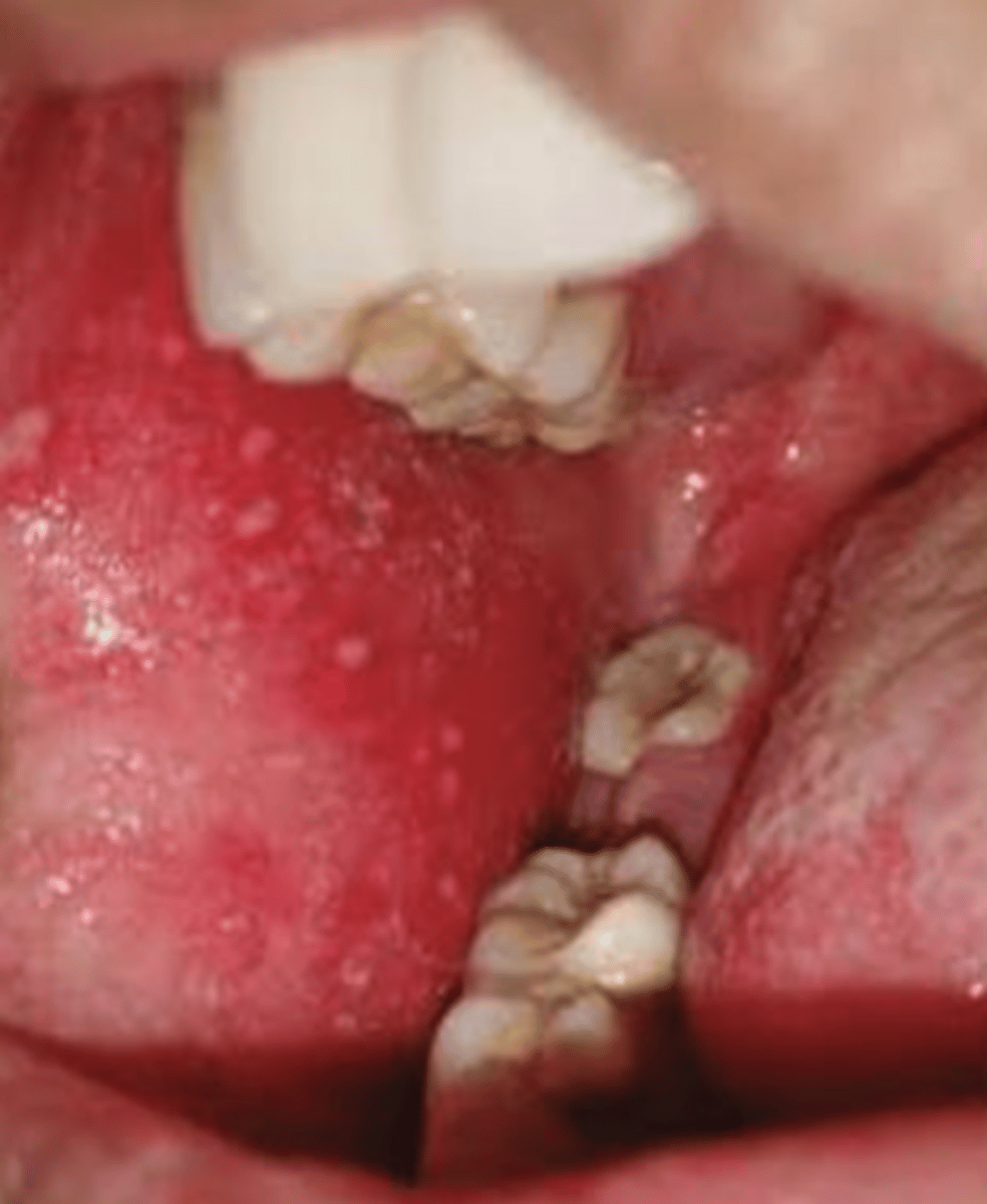 <p>Koplik spots; these CANNOT be rubbed off</p>