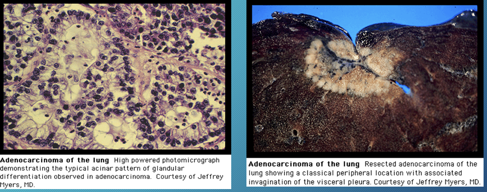 <p>most common form in nonsmokers</p><p>peripheral lesion</p><p>-bronchoalveolar cell carcinoma/ adenocarcinoma in situ: subtype of adenocarcinoma</p><p>solitary nodule, lobar consolidation or multiple nodules</p><p>slow growing with late metastases</p><p>lower likelihood of + PET scan</p>
