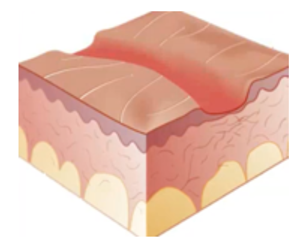 <p>Secondary Skin Lesion</p><ul><li><p><strong>Degeneration</strong> of skin</p></li><li><p>Loss of <strong>elasticity</strong> and <strong>texture</strong> of skin normally</p></li><li><p>Common to <strong>elderly only</strong> (e.g., aged skin)</p></li><li><p>Presence on <strong>young</strong> px indicates <strong>dehydration</strong></p></li></ul><p></p>