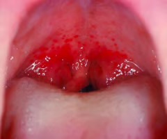 <p>redness of throat</p>