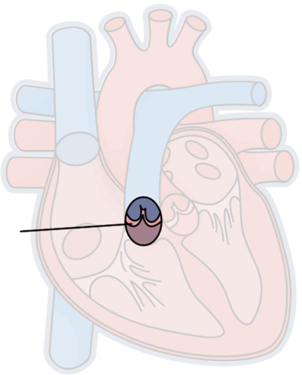 <p>Btwn the right ventricle &amp; pulmonary arteries</p>