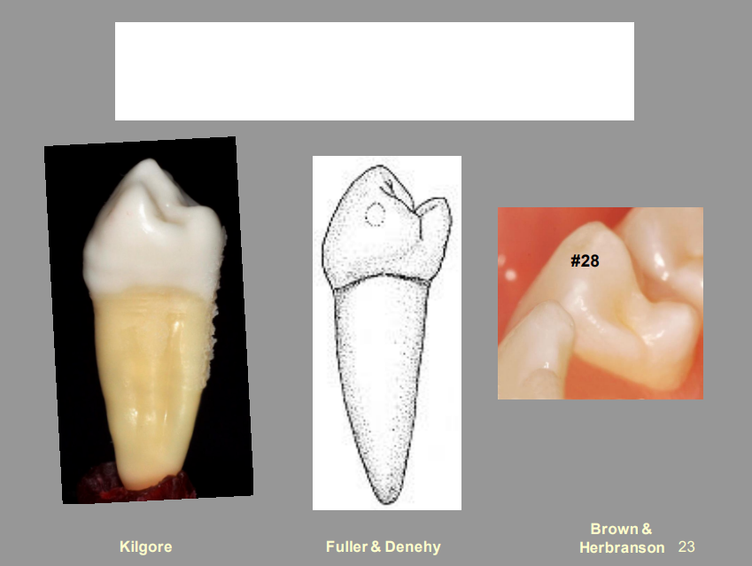 <p>From the Picture Shown, What Tooth Is This, And What View?</p>