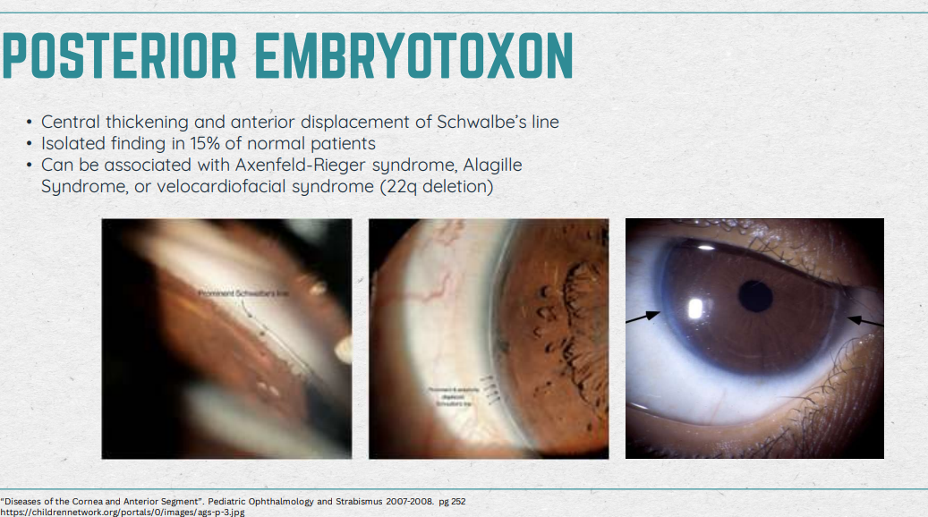 <ul><li><p>Characteristic: Central thickening and anterior displacement of Schwalbe’s line; Around limbus of cornea</p></li><li><p>Can be present in normal Pts</p></li><li><p>Associated diseases: Axenfeld-Rieger syndrome, Alagille Syndrome (liver), or Velocardiofacial syndrome</p></li><li><p>Get reall good IOP! Check for precursor for glaucoma</p></li></ul><p></p>