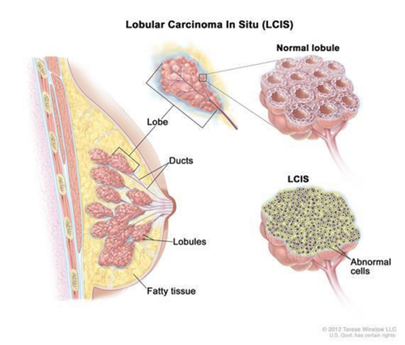 <p>It is a marker of increased bilateral breast cancer risk and a potential precursor to invasive carcinoma.</p>