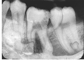 <p>How would you resolve this FINGERPRINT ARTIFACT X-ray?</p>