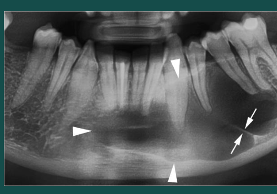 <p>Developmental/odontogenic RL lesions</p><p>well defined RL</p><p>smooth borders, scalloping may occur between roots</p><p>can be uni or multiocular</p><p>strong preference for posterior mandible&nbsp;</p><p>high recurrence rate&nbsp;</p>