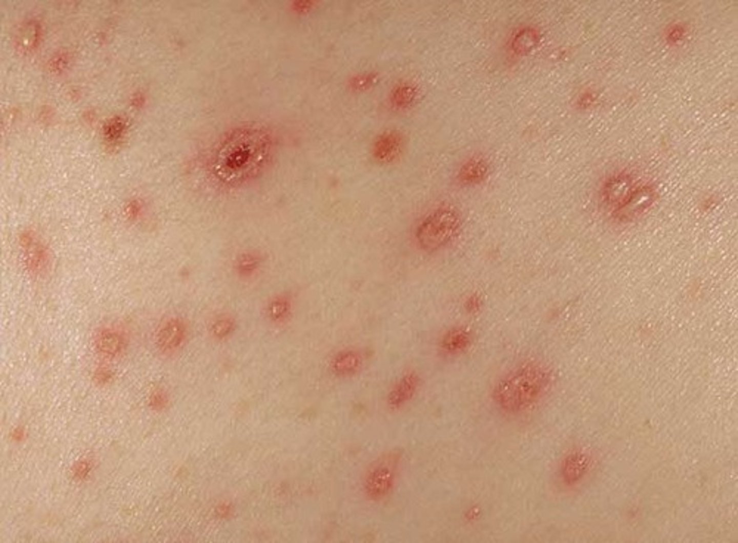 <p>Caused by the Varicella zoster virus, airborne, Treatments are painkillers, itch-relievers, fever-relievers, varicella vaccine.</p>