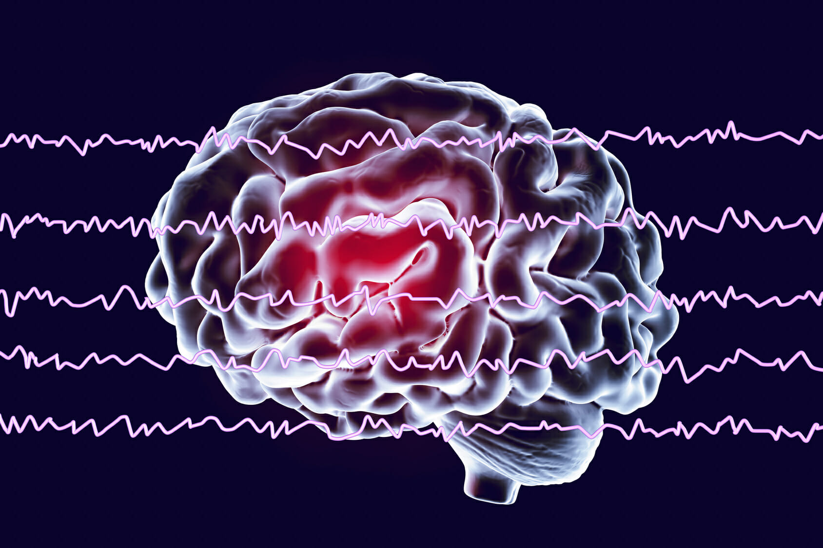 <p>electrical waves; detects seizures</p>