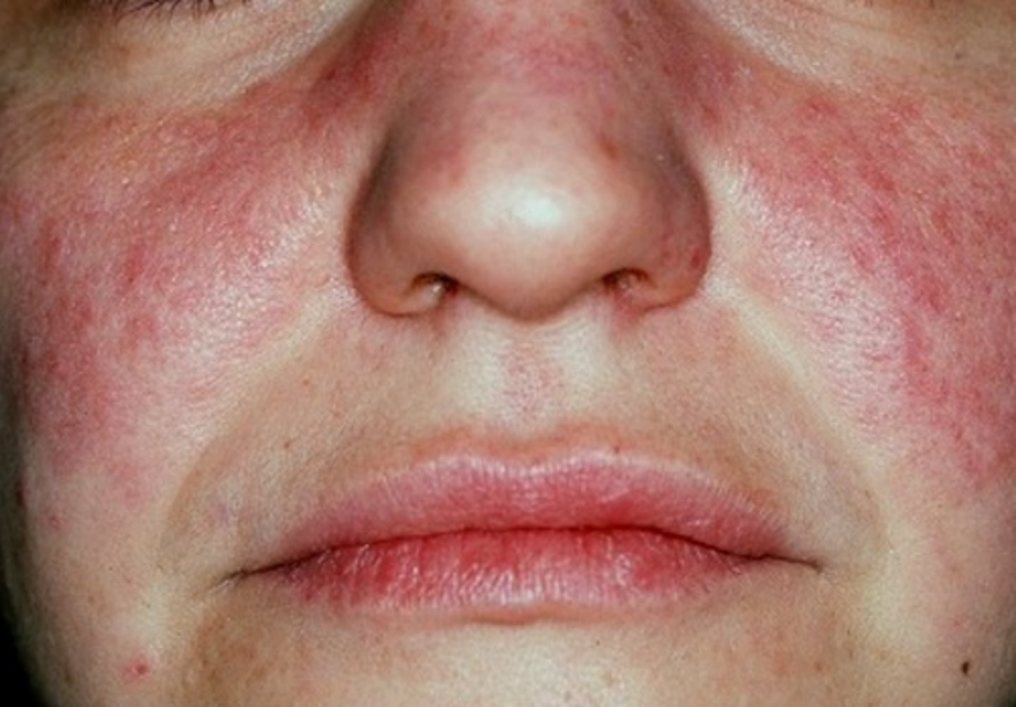 <p>Hint: Most common collagen vascular immune mediated condition in the US</p>