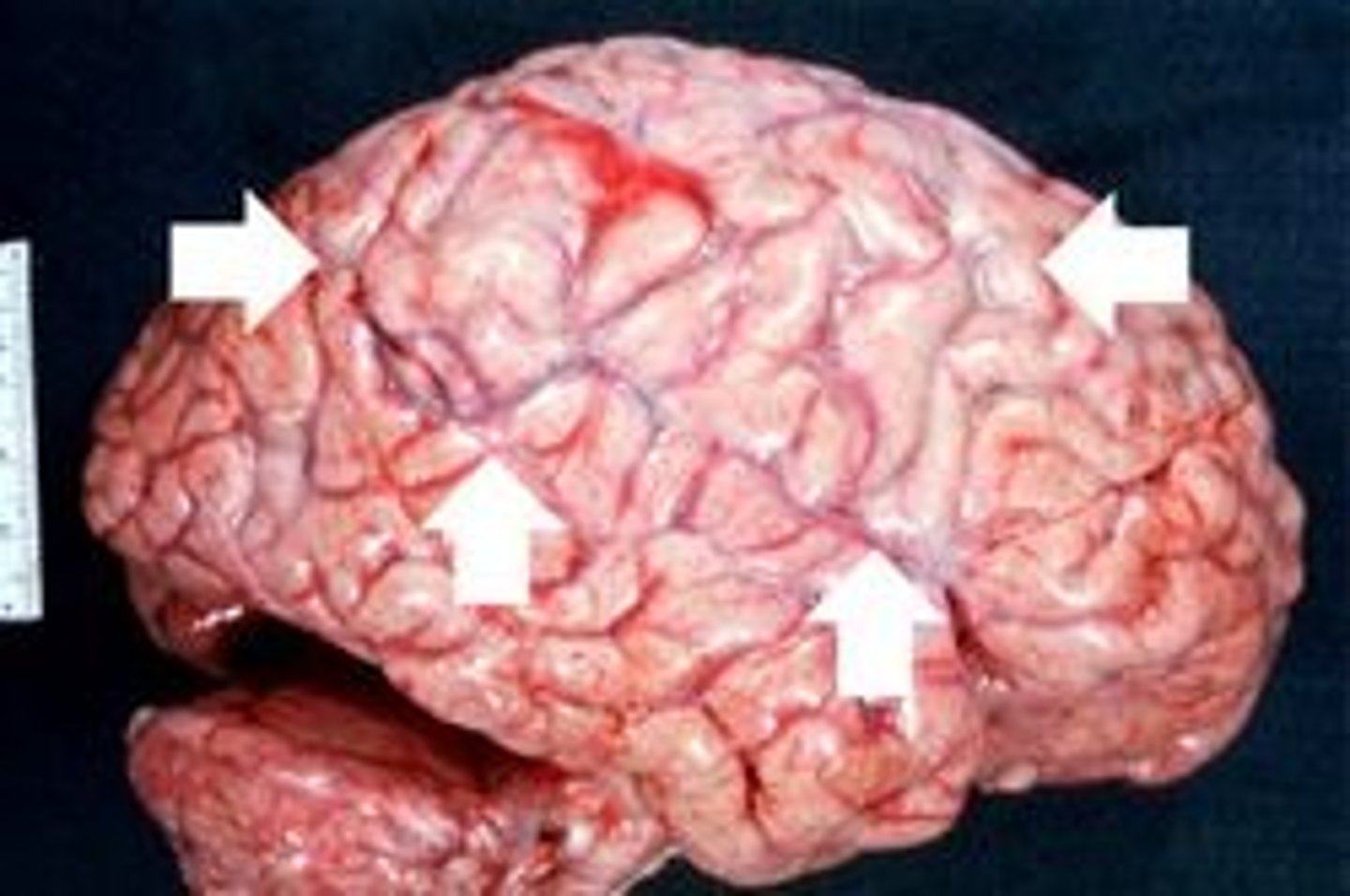 <p>Pathogen: Haemophilus influenzae, Neisseria meningitidis, Streptococcus pneumoniae</p><p>S+S: Fever, headache, nuchal rigidity</p><p>Transmission: Respiratory or oropharyngeal secretions </p>