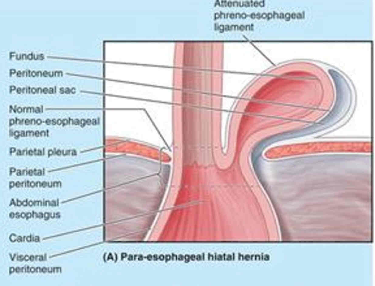 <p>- Less common</p><p>- Fundus and pouch of peritoneum protrude<br><br>- No regurgitation because Cardia stays in place</p>