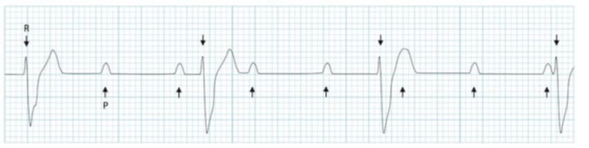 <p>what rhythm is shown in the ECG?</p>