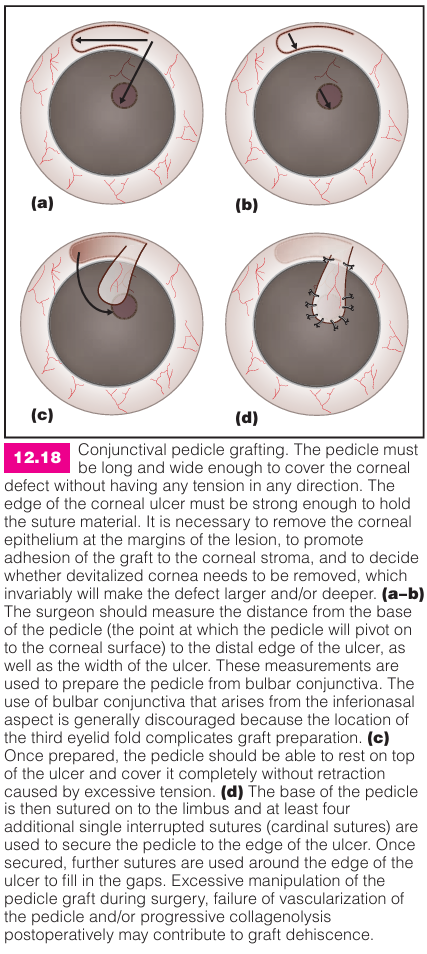 <p>A tissue covering used for deep or slow-healing corneal lesions.</p>
