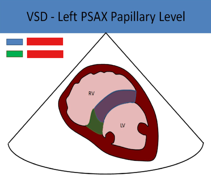 <p>what vsds are pictured</p>