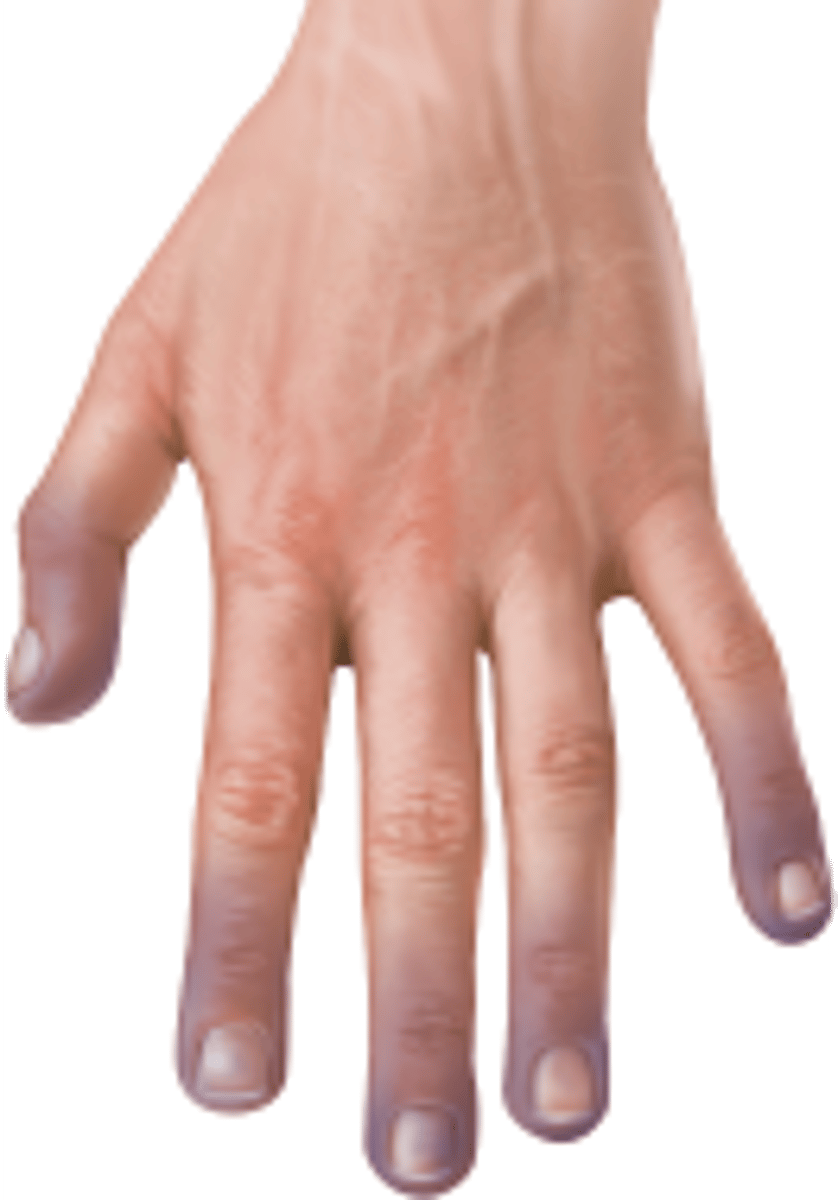 <p>a bluish appearance to the skin; a sign that the tissue isn't receiving enough oxygen</p>