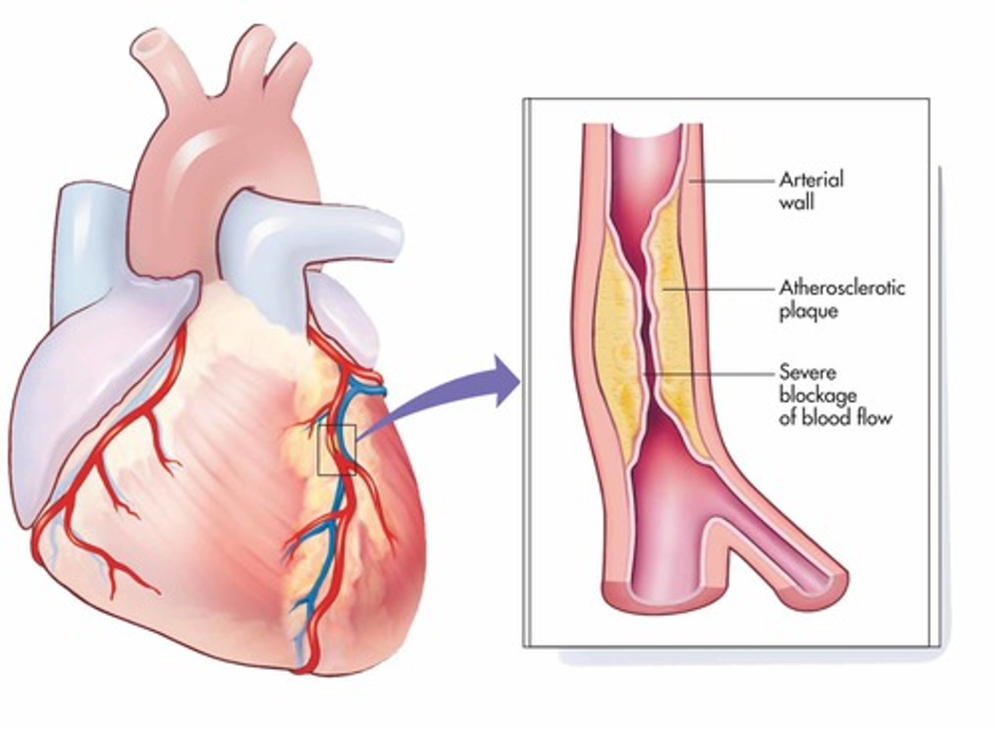 <p>- causes abnormal rhythms<br><br>- shortness of breath<br><br>- potentially cause small changes to structure of heart<br><br>(similar to changes seen in early stages of heart failure)</p>