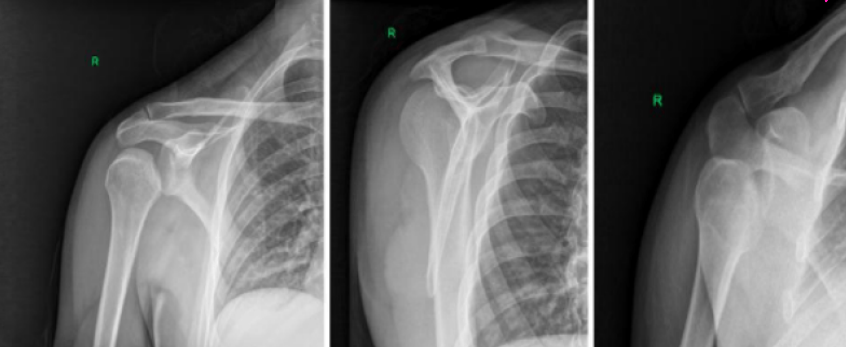 <p>What type of shoulder dislocation can be seen here?</p>