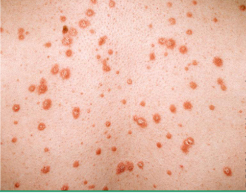 <p>what subtype of psoriasis?</p><ul><li><p>abrupt onset multiple small psoriatic papules and scales w/ <strong>raindrop appearance</strong></p></li><li><p><strong>may spontaneously remit</strong></p></li><li><p>trunk, back, proximal extremities</p></li><li><p>children/young adult w/ <strong>recent strep infx</strong></p></li></ul><p></p>