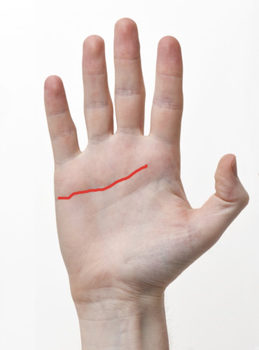 <p>This crease lies at the base of the fingers and marks the location of the proximal pulley:</p><p>A. Distal palmar crease</p><p>B. Hypothenar crease</p><p>C. PIP crease</p><p>D. Thenar crease</p><p>D. Proximal palmar crease</p>