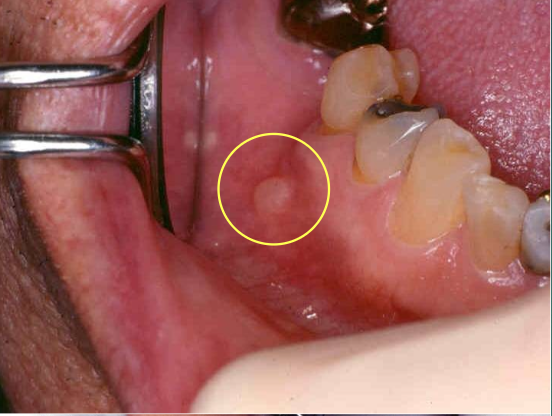 <p>In which population is a salivary duct cyst more common in?</p>