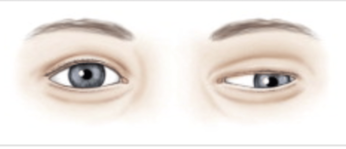 <p>Pupil dilated and fixed; eye deviated laterally and downward; ptosis</p>