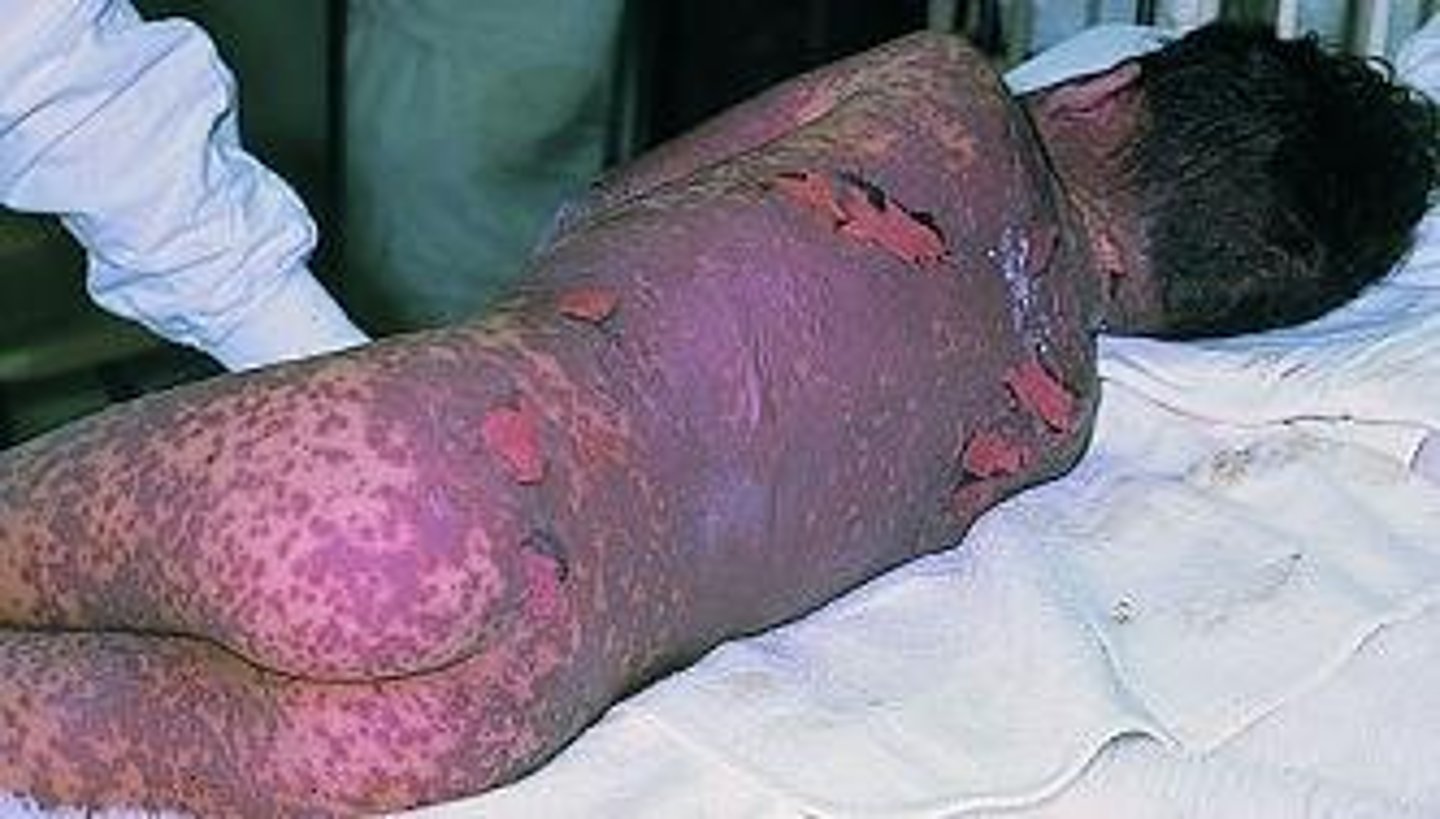 <p>detachment of &gt;30% of the body</p><p><strong>Type IVc</strong></p><p>-commonly caused by meds </p>