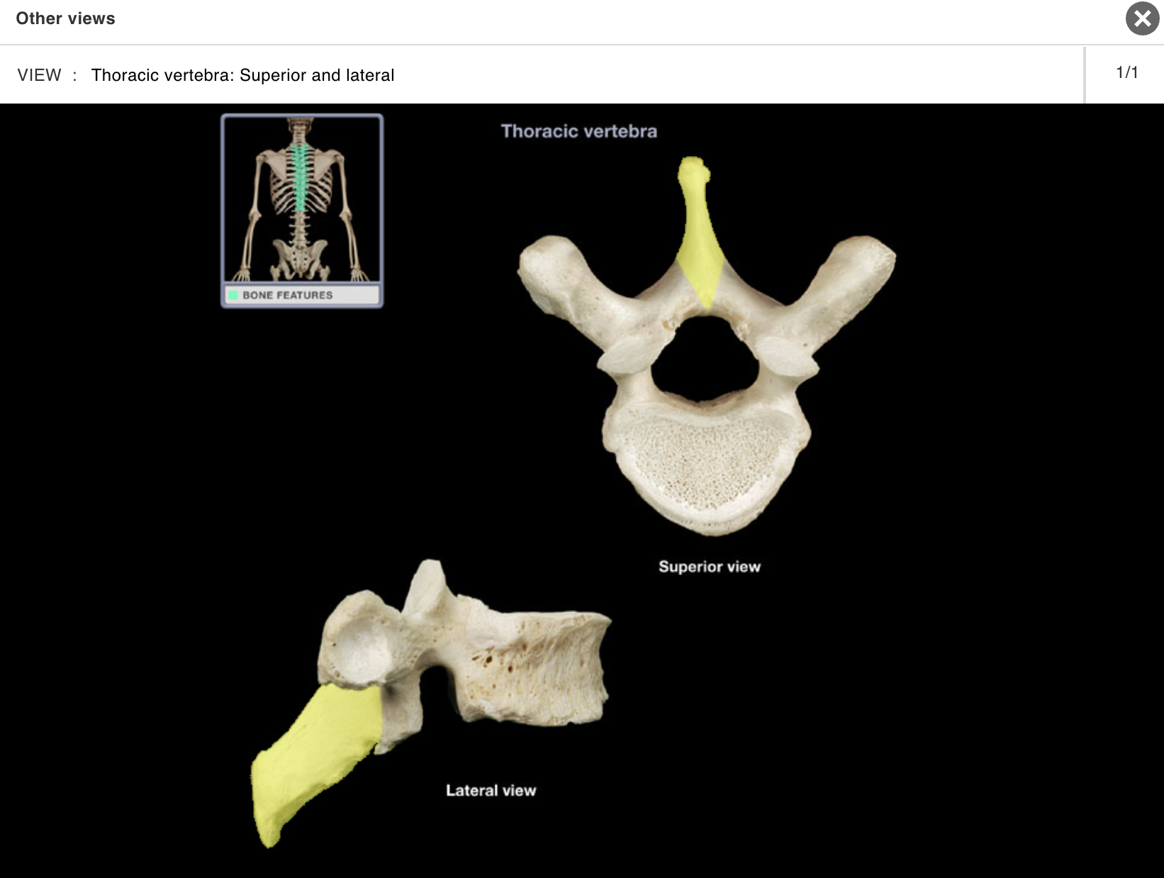 <p>Location:</p><p class="p1">• Thoracic vertebra</p><p class="p1">Description:</p><ul><li><p>﻿﻿Unpaired posterior midline projection from vertebral arch</p></li><li><p>﻿﻿Has characteristic long, slender form</p></li><li><p>﻿﻿Processes of inferior thoracic vertebrae directed inferiorly</p></li></ul><p class="p1">Comment:</p><p class="p1">• Spinous process present on all vertebrae except atlas (C1 vertebra) and coccygeal vertebrae</p><p class="p1">• Provides attachment for muscles and ligaments</p>