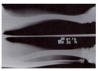 <p>bone can permanently bend!</p><p>(like in Rickets)</p>