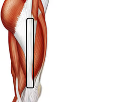 insertion of tensor fasciae latae
