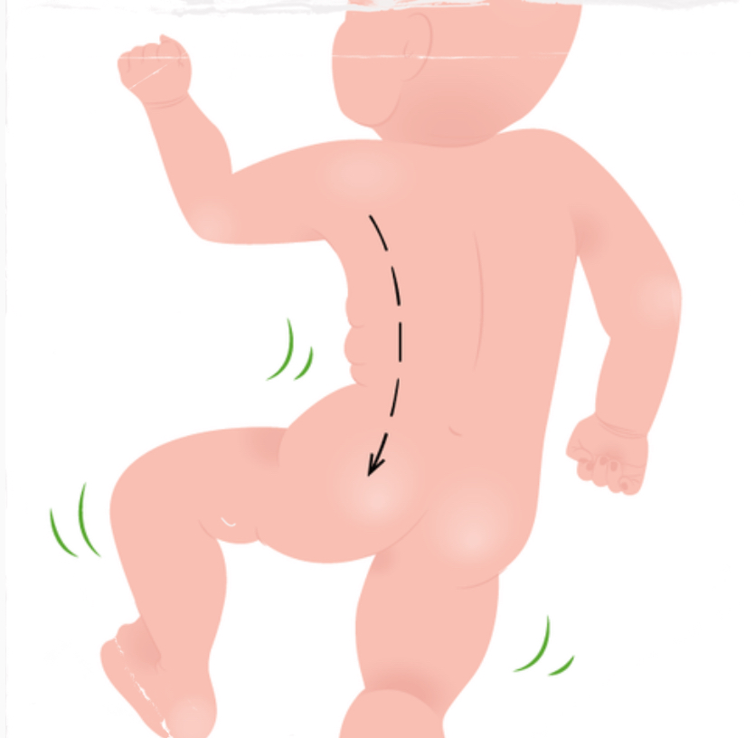 <p><strong>Neonatal Infant Reflex: </strong>Spinal Galant (Pre-natal onset, help get thru birth)</p>