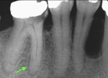 <ul><li><p><strong>Widened PDL</strong></p></li><li><p><strong>Pulpal Disease</strong></p></li></ul><p></p>